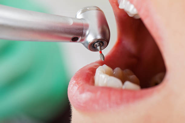 Best Emergency Root Canal Treatment in White Settlement, TX